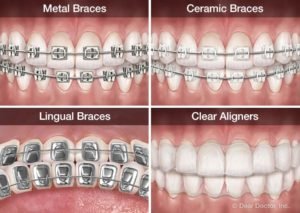 Different Types Of Orthodontic Treatment